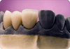 Dental Precious Porcelain Crown