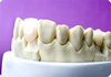 Dental Porcelain Crown
