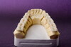 Dental Porcelain Bridge