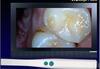 Intra Oral Camera
