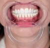 Check Retractor