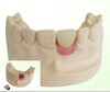Titanium Implant