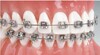 One-Piece Brackets