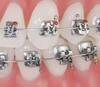 Self-Ligating Brackets