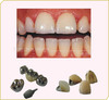 Porcelain Fused Metal Crowns