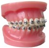 Self-Ligating Bracket Model