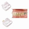 Orthodontic Ceramic Bracket