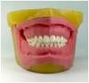 Oral Anesthetic Tooth Extraction Model