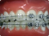 Ceramic Bracket3-3