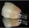 Implants