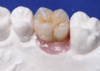 Implant System (4)