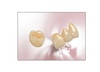 High-Intensity Porcelain Teeth