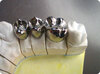 Dental Full Titanium Metal Crown