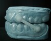 Dental Snore Guard Silensor