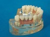 Dental Implant