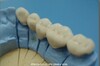 Porcelain-Fused-to Metal Dental Crown-1