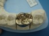 Full Gold Crown (008)