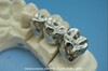 Full Metal Crown Co-Cr (008)