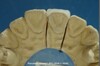 Dental Empress Veneer (008)