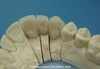 Zirconia Crown (008)