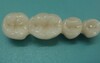 Porcelain-Fused-to-Metal Dental Crown-2