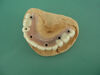 Dental Implant Crown