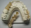 Zircon Crowns - 1