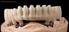 Implant +Zircon Bridge