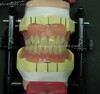 Full Acrylic Dentures