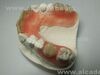 Valplast