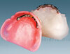 Implant Denture (0007)