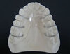Othodontic-Retainer