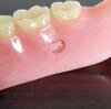 BPS Denture