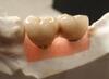 Implant Crowns