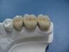 P.F.M Non Precious Teeth