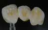 Empress II Teeth (PBCJ)