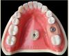 Implant