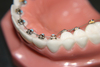 STB Lingual Bracket/Brace - Dental Brace