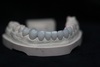 Emax Veneer