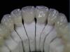 Procera Zirconia