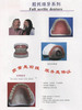 Acrilic Denture